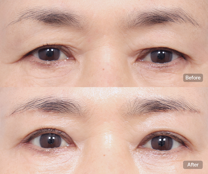 AB Plastic Surgery Eyes that look as youthful and beautiful as they did 10 years ago. visual