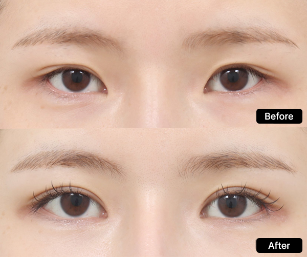 AB Plastic Surgery Epicanthoplasty visual