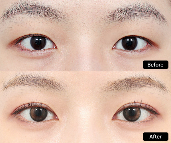 AB Plastic Surgery For a beautiful double eyelid line visual