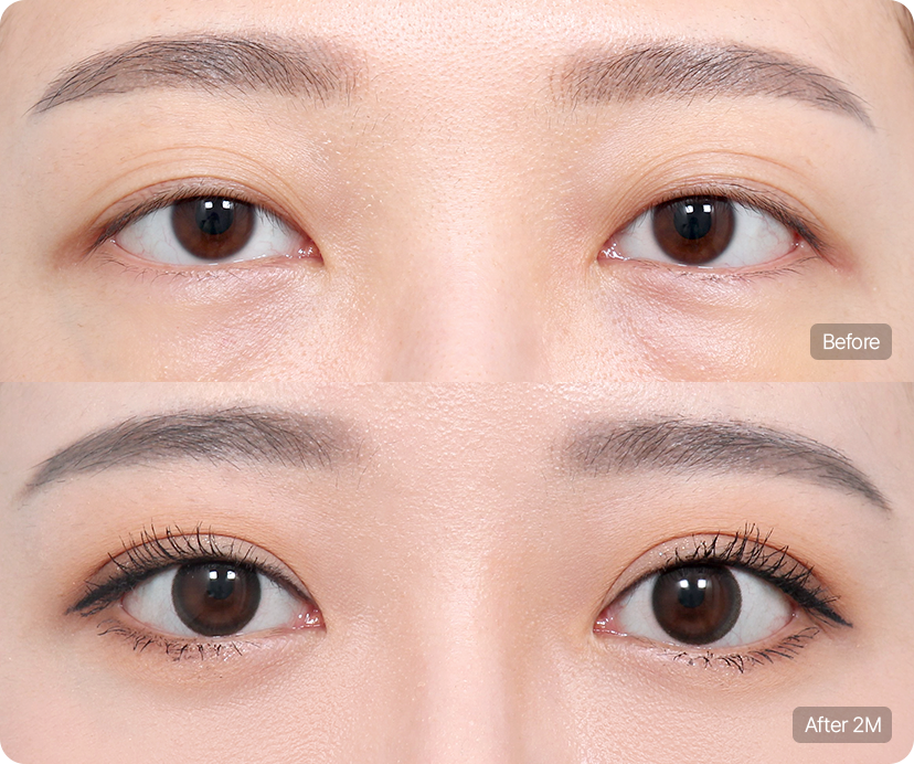 AB Plastic Surgery Brighter Eyes With Ptosis Correction visual