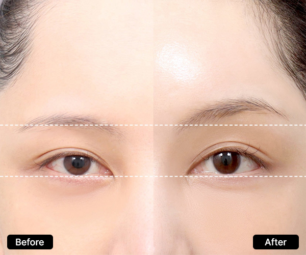 AB Plastic Surgery Eyebrow Lifting for Refreshing and Beautiful Eyes visual