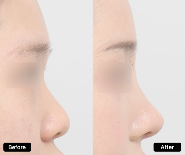 AB Plastic Surgery Accurate flat nose analysis visual