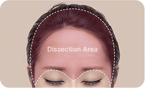 STEP 2. surgery illustration