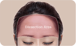 STEP 2. surgery illustration