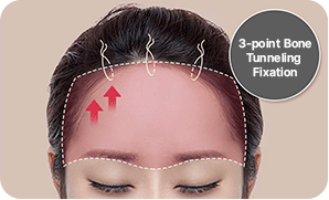 STEP 3. surgery illustration
