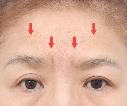 Before and After