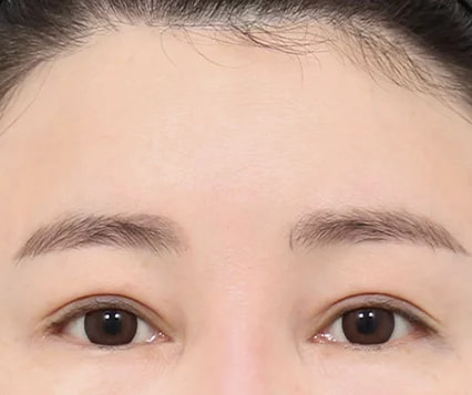 Before and After