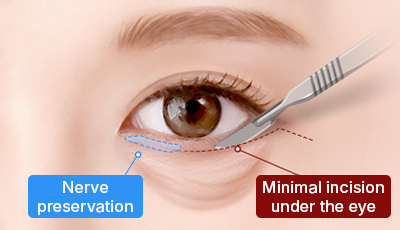 01. Minimal incision surgery illustration