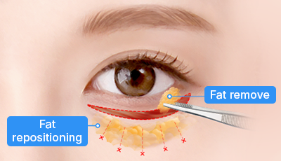 02. Fat removal or repositioning, and septal reinforcement surgery illustration
