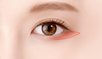 04. Excise the excess skin and suture. surgery illustration