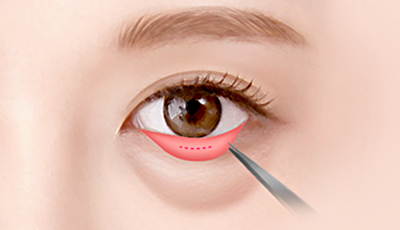 02. Make a tiny incision inside the conjunctiva to 
    ensure that scars are not visible. surgery illustration