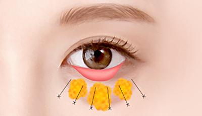 03. Redistribute excessive under-eye fat smoothly to fill in hollow areas surgery illustration