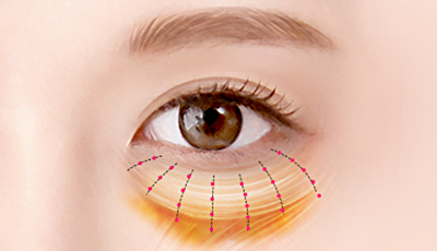 04. Reposition the lax orbital septum to restore tension, then secure and suture it in place surgery illustration