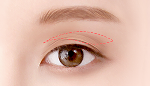 02. Before surgery design surgery illustration