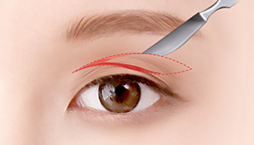 03. Make an incision along the crease of the eye with a double eyelid line surgery illustration