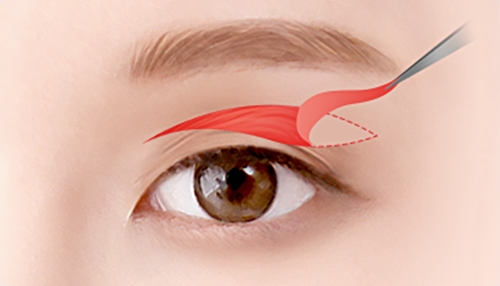 04. Droopy eyelid skin, fat and muscle removal surgery illustration