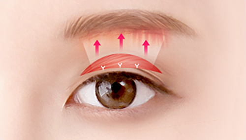 05. Removal of sagging muscles followed by firm fixation of the fascia surgery illustration