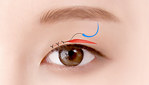 06. Suturing surgery illustration