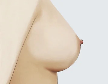 Normal Breasts