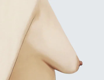 Pseudo-Ptosis