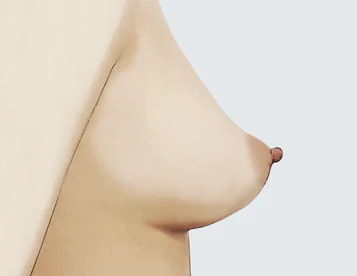 Other Atypical Breast Shapes