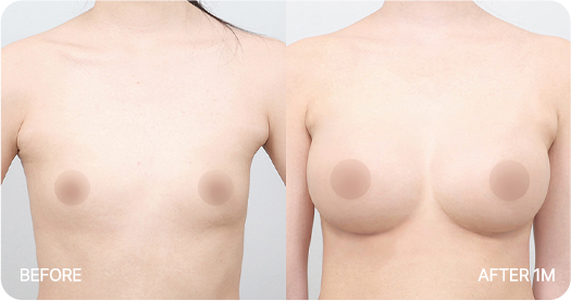 Ab Surgery