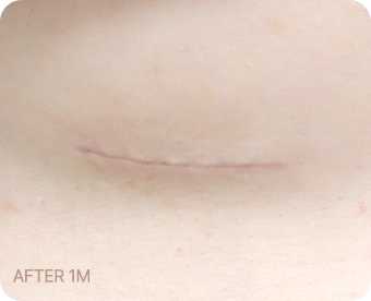 Ab Surgery