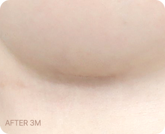 Ab Surgery