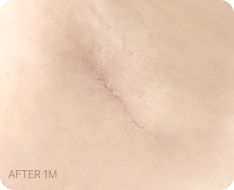 Ab Surgery