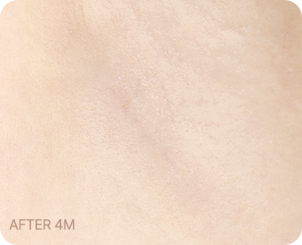 Ab Surgery