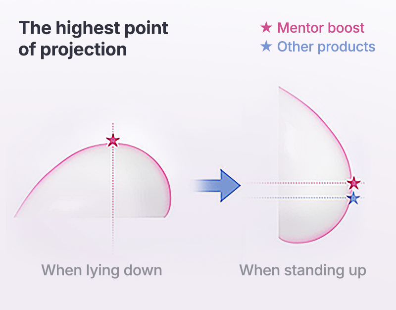 Compared to other Mentor products, the nipple is positioned more securely and the highest protruding point naturally adjusts according to individual movements. surgery illustration