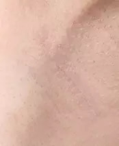 Transaxillary Incision Area after 2 months