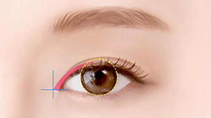 Step 2. Design surgery illustration