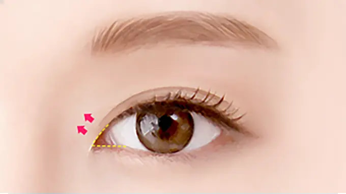 Step 4. Suture surgery illustration
