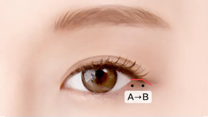 Step 1. Incision of Skin Conjuctiva surgery illustration