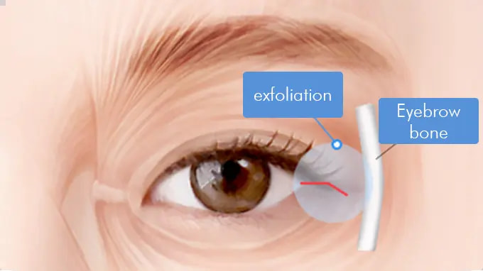 Step 2. Orbicularis Oculi Muscles Desquamation surgery illustration