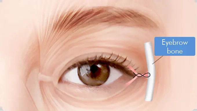 Step 3. Secured at Periosteum surgery illustration