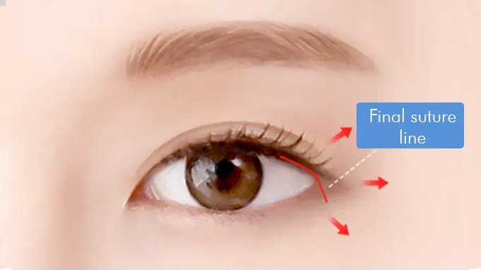 Step 4. Suture surgery illustration