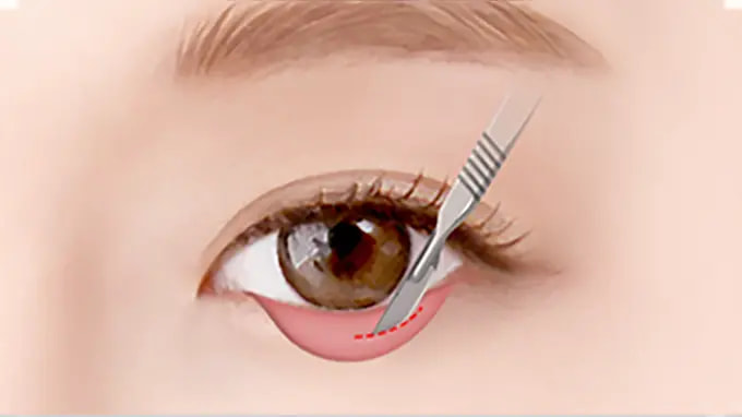 Step 1. Incision of Skin Conjuctiva surgery illustration