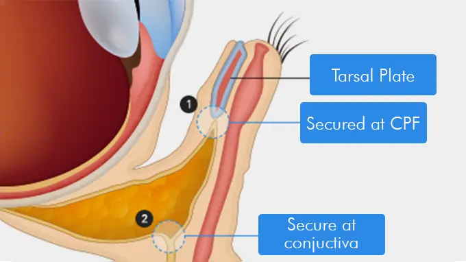 Step 2. The Tarsal Plate Is Anchored to the
    Periosteum or CPF surgery illustration