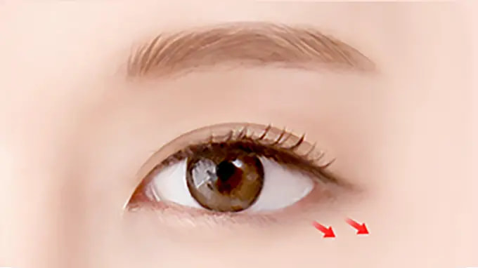 Step 3. After Surgery surgery illustration