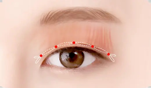 STEP 3. Surgery progress surgery illustration