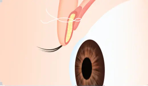 STEP 4. Inducing natural adhesion surgery illustration