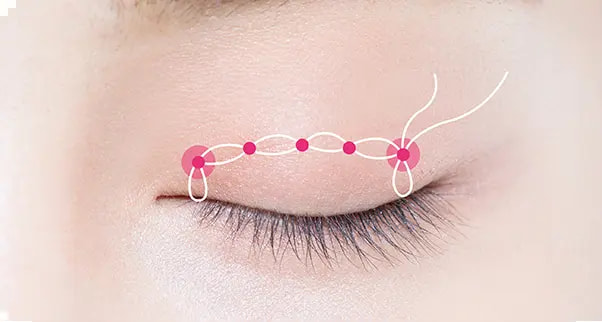 Surgery illustration