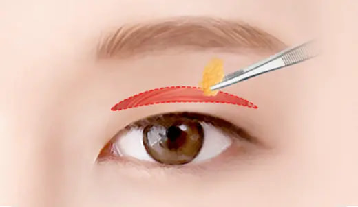 STEP 2. Muscle and fat removal after incision surgery illustration