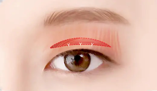 STEP 3. Line fixation, Ptosis Correction if necessary surgery illustration