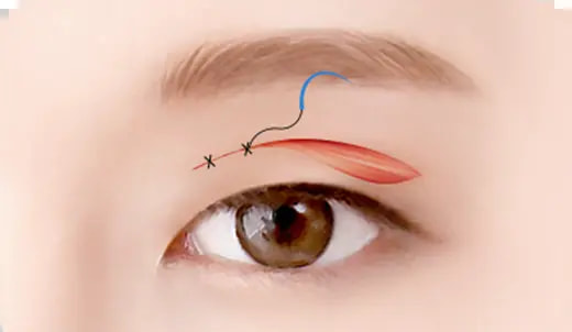 STEP 4. Suture surgery illustration