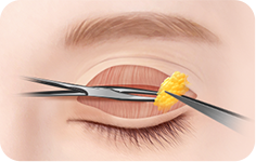 02. STEP surgery illustration