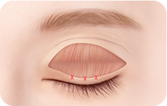 03. STEP surgery illustration