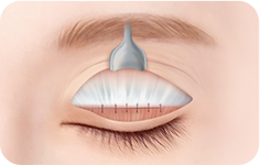 04. STEP surgery illustration